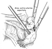 Gravidanza extrauterina