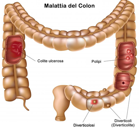 Malattia Colonretto